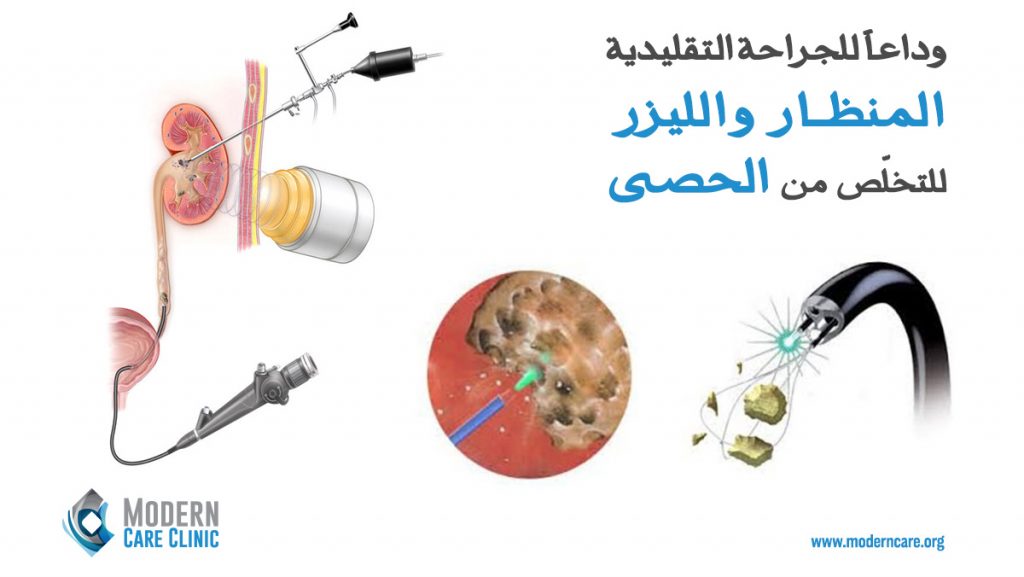 وداعاً للجراحة التقليدية… المنظار والليزر للتخلّص من الحصى