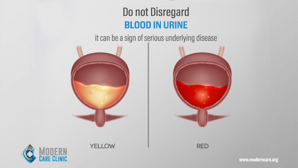 Blood in urine