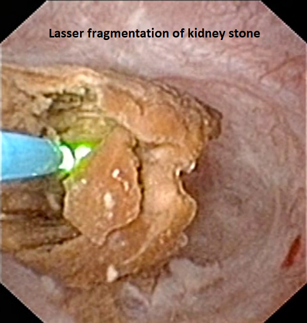 Laparoscopic NephroUreterectomy