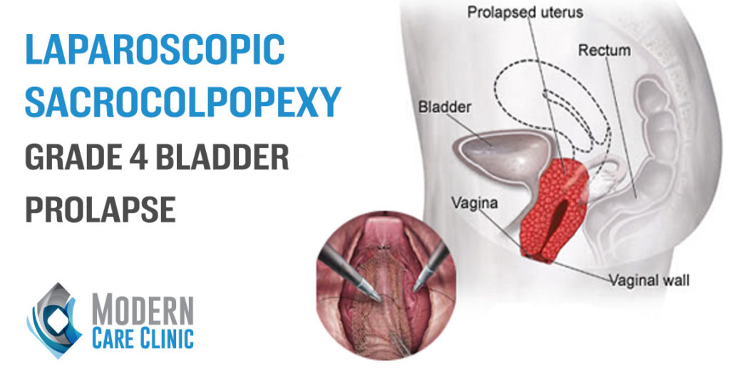 Laparoscpoic