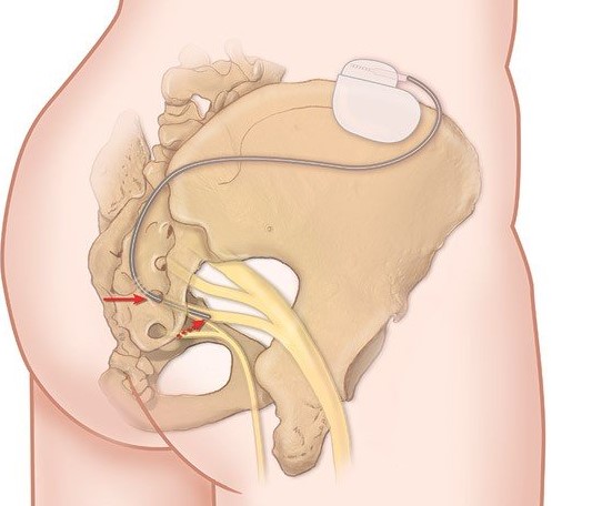 Sacral Neuromodulation