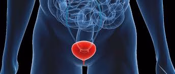 Bladder cancer