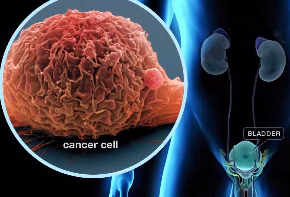 Maintenance Therapy For Bladder Cancer 1