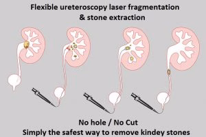 Flexible laser ureteroscopy and stone extraction