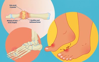 Facts About Gout