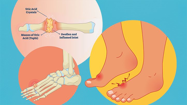 Facts About Gout