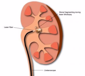 Kidney stones - treatment and prevention tips