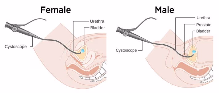 cystoscopie