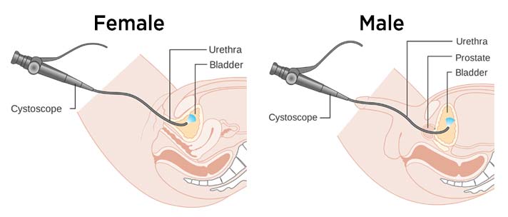 Learn about Cystoscopy!