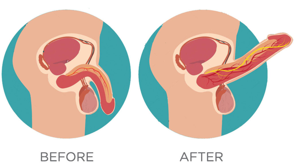 PRP for erectile dysfunction