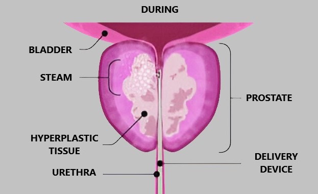 Rezum Procedure BPH Guide 4