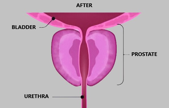 Rezum Procedure BPH Guide 5