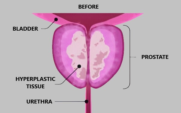 Rezum Procedure BPH Guide 3