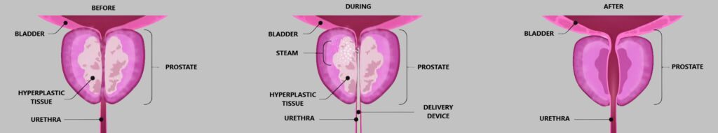 Rezum Procedure BPH Guide 2