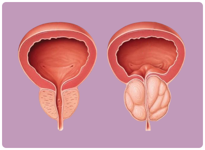 prostate