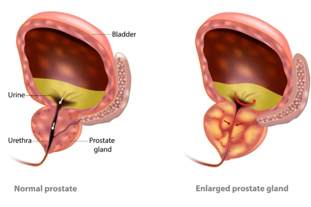 Rezum vs. Traditional BPH Treatments: Understanding Your Options for an Enlarged Prostate 2