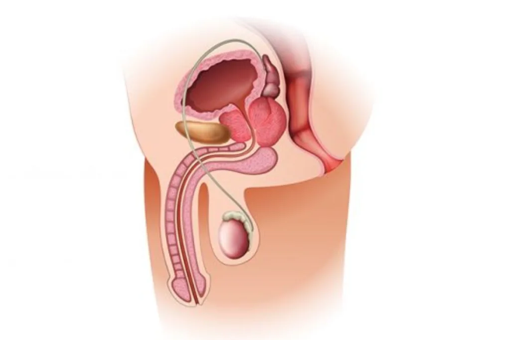 Living with Peyronie's: Expert Strategies for Managing Pain and Improving Function 3