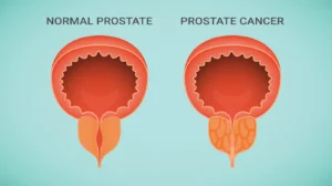 PROSTATE CANCER