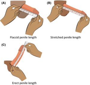 Penile Length
