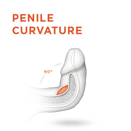 Peyronie's