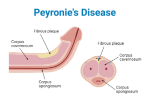Peyronie's Disease