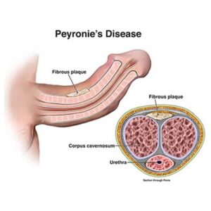 Peyronie's