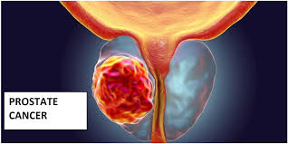 Prostate Cancer