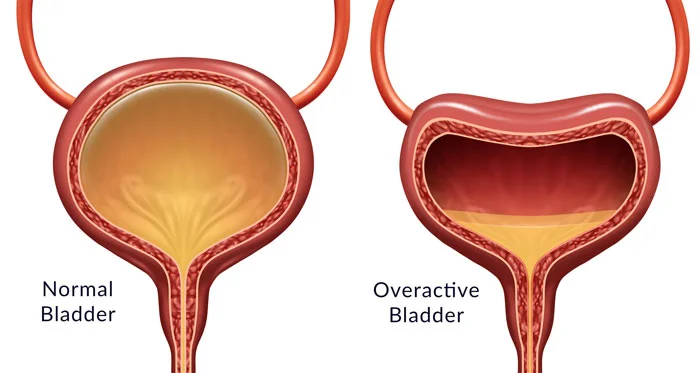 Overactive Bladder
