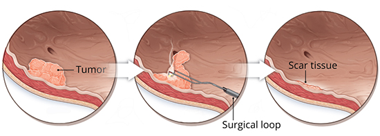 bladder tumor biopsy