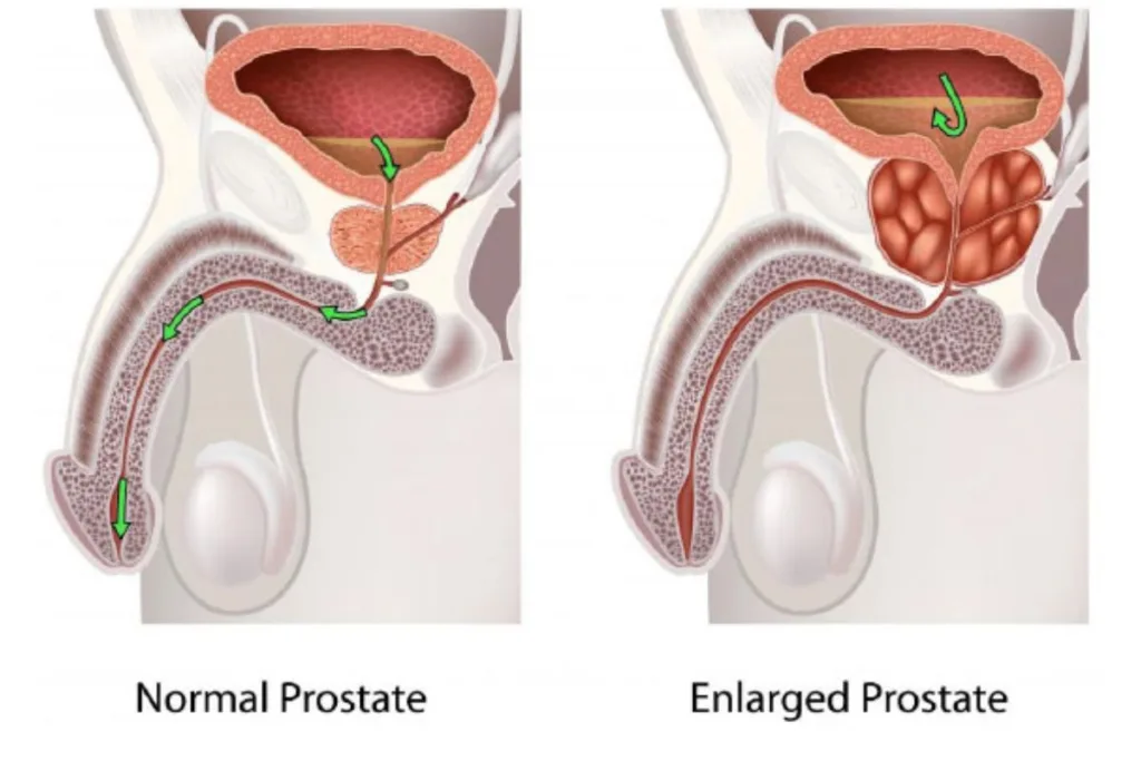 Common Mistakes Men Make When Managing an Enlarged Prostate 2