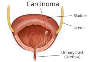 Bladder Tumor
