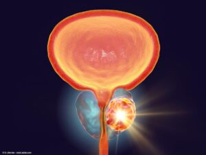 prostate cancer