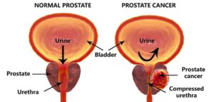 Prosstate Cancer